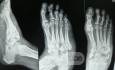 Charcot's foot