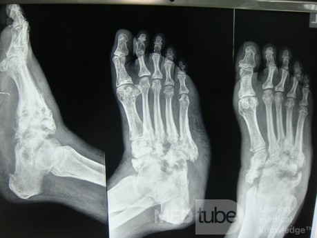 Charcot's foot
