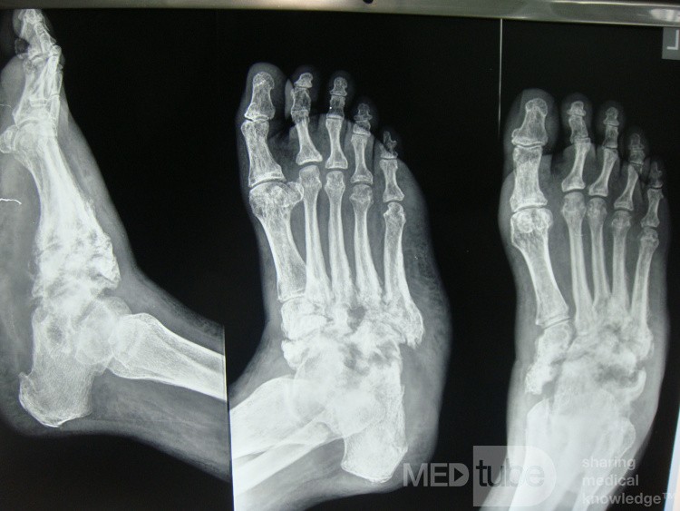 Charcot's foot