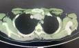 VATS Thymectomy