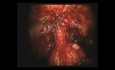 Robotic prostatectomy in HD - DaVinci Surgery - part 2