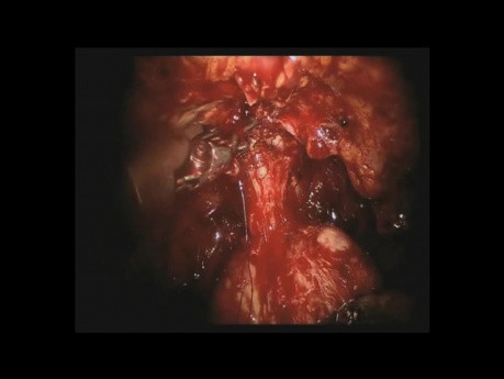 Robotic prostatectomy in HD - DaVinci Surgery - part 2