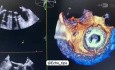 Mitral Valve and Paravalvular Leak