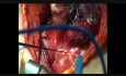 Intraoperative Recurrent Laryngeal Nerve Monitoring During Thyroidectomy by Using NIM-Response 3.0