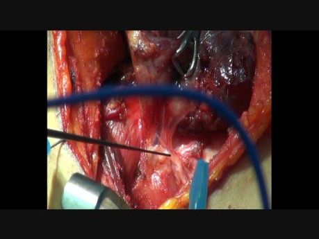 Intraoperative Recurrent Laryngeal Nerve Monitoring During Thyroidectomy by Using NIM-Response 3.0