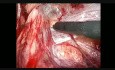 Laparoscopic Groin Hernia Repair, Step 4: Right Side Dissection
