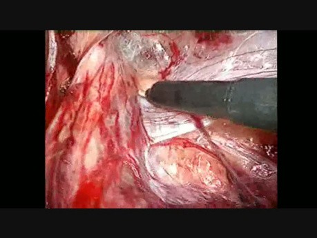 Laparoscopic Groin Hernia Repair, Step 4: Right Side Dissection