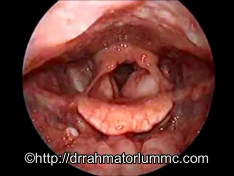 Mass in the Supraglottic Area