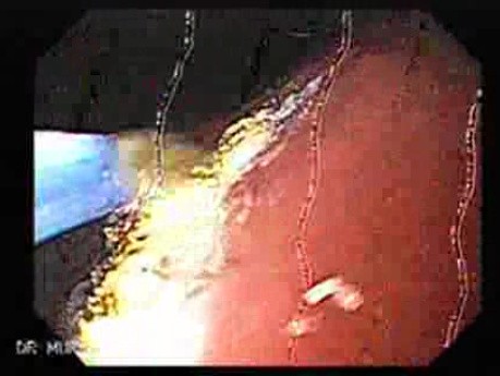 Hyperplastic Polyp - Endoscopy (6 of 8)