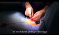 Subclavian Vein - Port-A-Cath