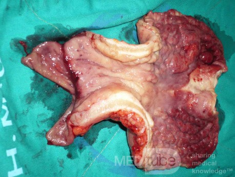Endoscopy of Scirrhous Gastric Carcinoma involving the entire Fundus, Body and the Antrum (37 of 47)
