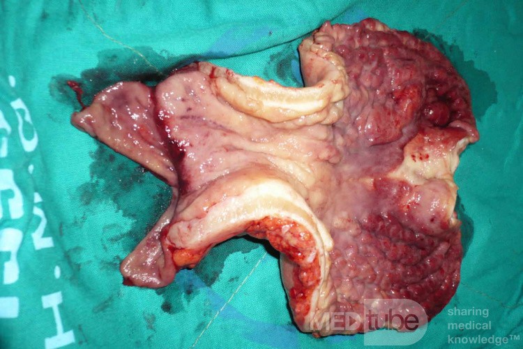 Endoscopy of Scirrhous Gastric Carcinoma involving the entire Fundus, Body and the Antrum (37 of 47)