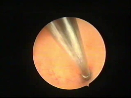 Cannulation of Proximal Tubal Blockage