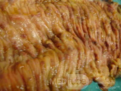 Toxic Dilatation of the Colon Superimposed pseudomembranous colitis involving the
 right colon (15 of 17)