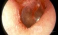 Normal Tympanic Membrane Red Reflex