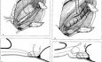 Shouldice Inguinal Hernia Repair