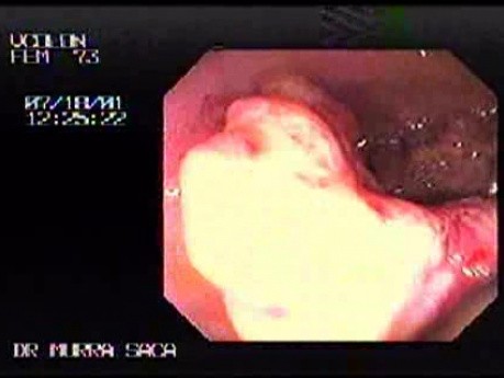 Rectal Adenocarcinoma With Acanthosis Nigrans Association