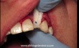 Temporary Bridge Using Denture Tooth And Ribbond