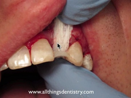 Temporary Bridge Using Denture Tooth And Ribbond