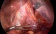 Laparoscopic Hiatal Hernia Repair