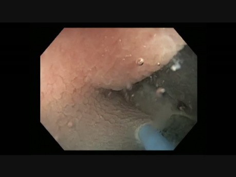 Colonoscopy - Ascending Colon SSA Resection