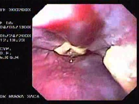 Banding of Esophageal Varices - Follow Up