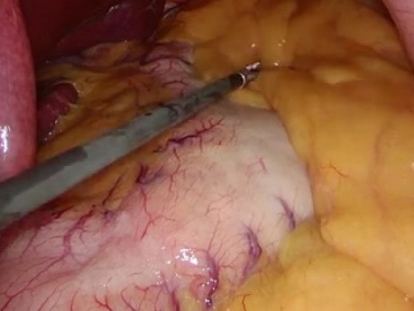Laparoscopic Sleeve Gastrectomy