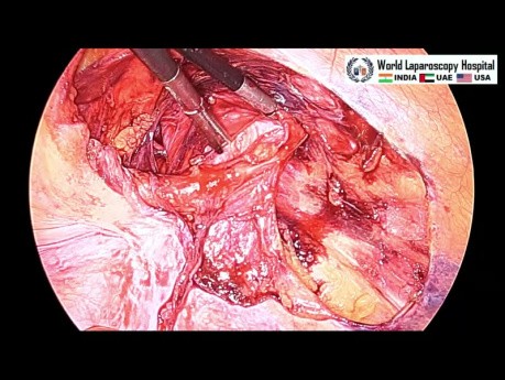 Inguinal Hernia Surgery (TAPP for Indirect Inguinal Hernia)