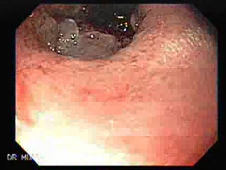 Distal Esophageal Squamous Cell Carcinoma - Gastroscopic Retroflexed Image
