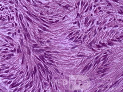 Jejunal Gastrointestinal Stromal tumor (GIST) (12 of 86)