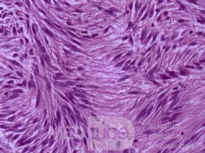 Jejunal Gastrointestinal Stromal tumor (GIST) (12 of 86)