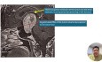 Transplanum Approach in Management of Firm Giant Pituitary Adenoma