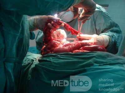 Mesenteric Ischemia (10 of 12)