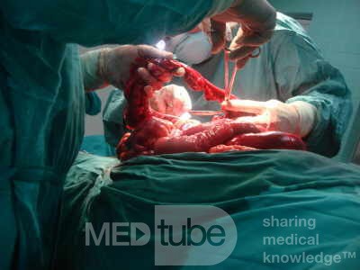 Mesenteric Ischemia (10 of 12)