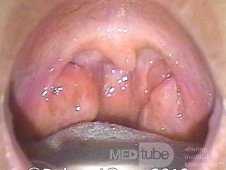 Tonsillar Hypertrophy