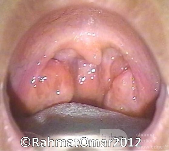 Tonsillar Hypertrophy