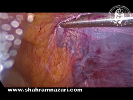 Spermatic Cord Lipomas