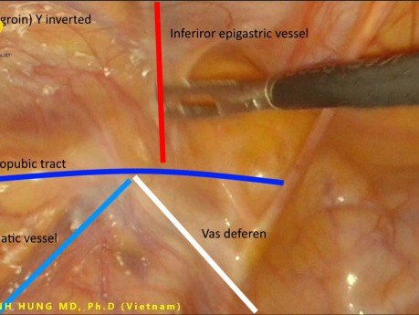 New Anatomical Concept for Lap Inguinal Hernia Repair