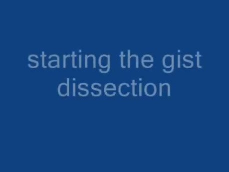Resection of GI stromal tumor
