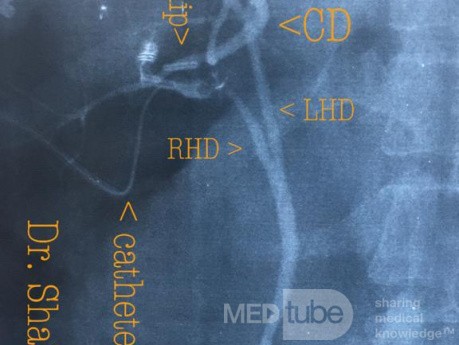 Junction of the Cystic Duct to Left Hepatic Duct