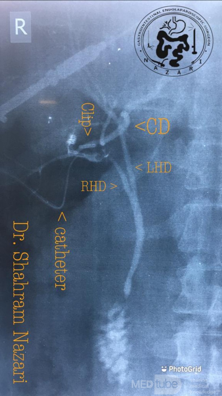 Junction of the Cystic Duct to Left Hepatic Duct