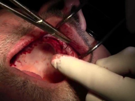 Suturing Technique - Implant Surgery, #10-11-12-13 Sites