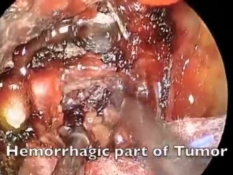Endoscopic Removal of Pituitary Apoplexy