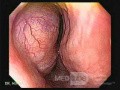 Gastrointestinal Stromal Tumors - Esophageal GIST
