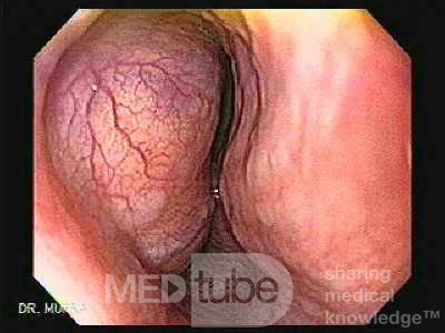 Gastrointestinal Stromal Tumors - Esophageal GIST