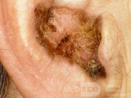 Basal Cell Carcinoma