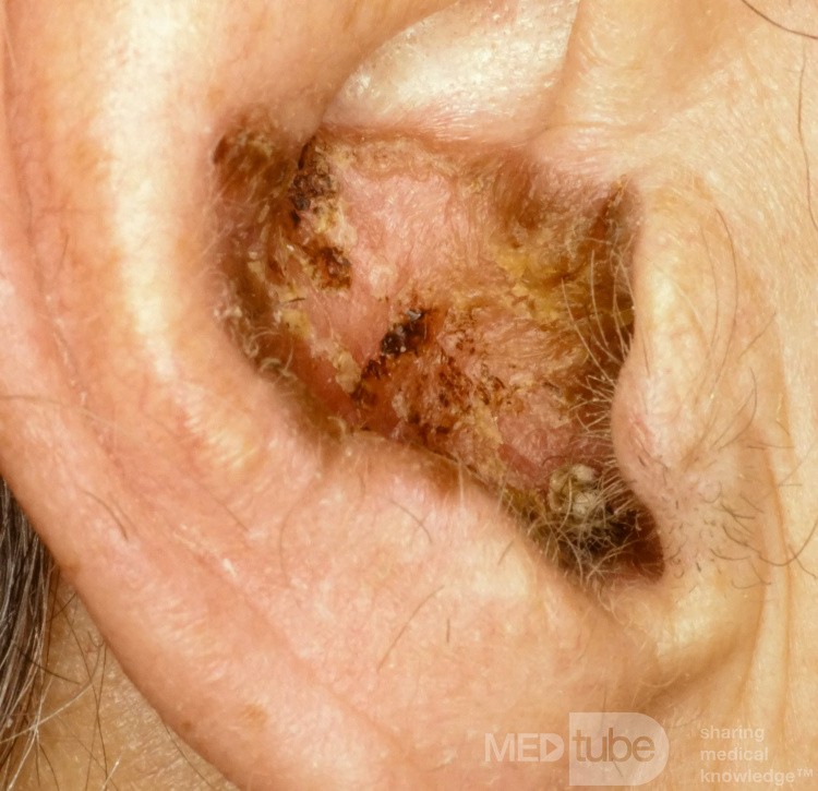 Basal Cell Carcinoma