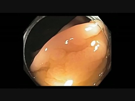 Colonoscopy Channel - Subtle Lesion in the Cecum Underneath a Fold