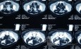 Appendicular Abscess CT 2