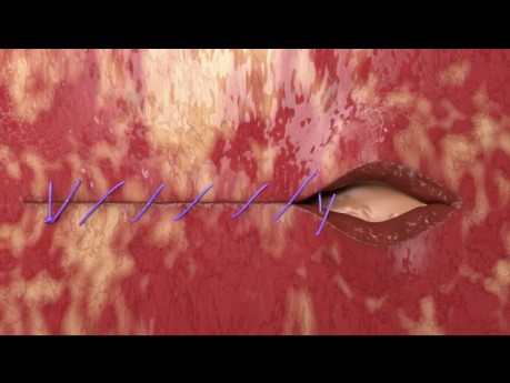 Vaginal Cuff Closure Unidirectional Quill® Barbed Suture Demonstration